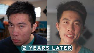 Accutane Didn't Last... Here's What Actually Worked