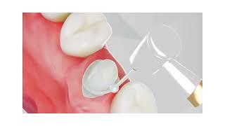 Dental Crowns