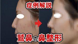 【鼻整形】鷲鼻って綺麗になるの？？実際の症例を解説します！！【経過写真あり！】@logicbeautyclinic