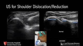 Ultrasound for Shoulder Dislocation/Reduction