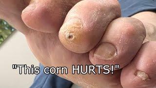  Hammer Toes & Dry Skin Cause Painful Corns   Expert Treatment by Dr. Binh | Healthy Feet Podiatry