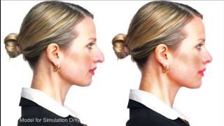 The Essential Video Guide to Rhinoplasty | Dr. Buonassisi, 8 West Clinic in Vancouver BC