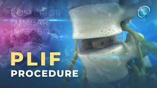 What is Posterior Lumbar Interbody Fusion? | PLIF