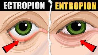 Ectropion and Entropion - Causes, Symptoms, Types and Treatment | Ectropion vs Entropion