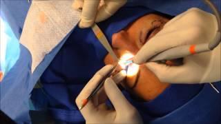 Transconjunctival Lower Blepharoplasty- Inside the OR, Dr. Navin Singh Washingtonian Plastic Surgery