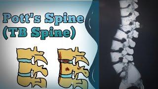 Koch spine |Potts spine| tuberculosis of spine | in Hindi & English #tbspine