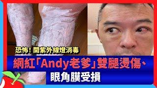 恐怖！ 開紫外線燈消毒　網紅「Andy老爹」雙腿燙傷、眼角膜受損 | 台灣新聞 Taiwan 蘋果新聞網