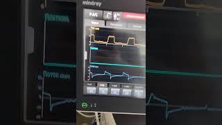 Mindray SV600 #anesthesiology