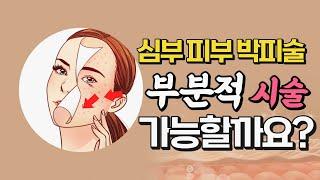 심부박피 입가주름 팔자주름 여드름흉터 부분적으로 치료 가능한가요? #심부박피#여드름흉터#주름