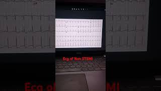 What other ecg changes do you see in Non STEMI?#nonstemi