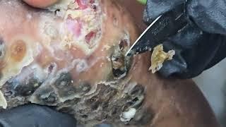 Harrison's fat jiggers extraction & debridement - subscribe @riseupsociety.net for long & 1000s more