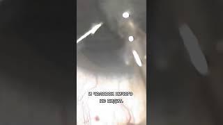 Удаление катаракты. Часть 7. Не затягивайте с лечением катаракты / Катаракта от А до Я