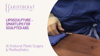 Liposculpture - SmartLipo for Sculpted Abs