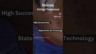 Best Clinic for Vitiligo Treatment #skinaa #viral #shortsviral