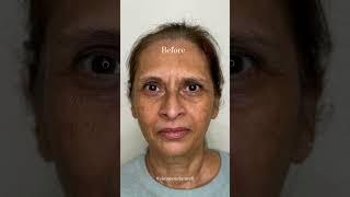 Melasma skin care guide