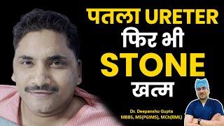 गुर्दे की पथरी का इलाज | Kidney Stone ख़तम - RIRS | Kidney Stone Laser Treatment #Rirs