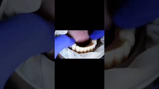 G - CAM DURABLE FUll Arch lower Bridge  ( Implant  SUPPORTED  ) fixing vedio!!