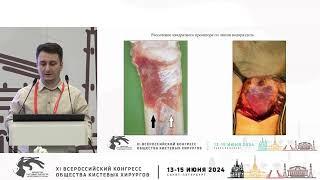 Мамедов Н.А.: модифицированный ладонный доступ к дистальному метаэпифизу лучевой кости.