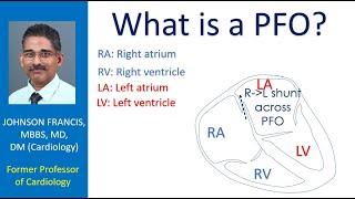 What is a PFO?