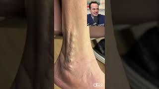 DOCTOR REACTS TO SCREWS COMING OUT OF ANKLE! #shorts #reaction