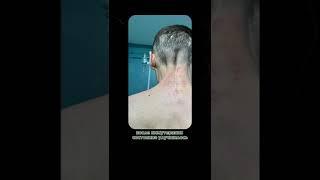 Отзыв пациента «Золотого фонда».                       диагноз:Нейрофиброматоз 2 типа.Стабильная д