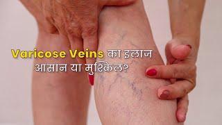 Varicose Veins: Causes, Symptoms, and Treatments | Surat Diabetic Foot and Ulcer Clinic