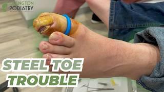 Double INGROWN Nail Removal!