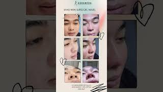 HIKO Nonsurgical Noselift