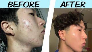 My Acne Journey (Skincare Motivation)