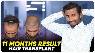 Hair Transplant in Salem | Best Results & Cost of Hair Transplant in Salem