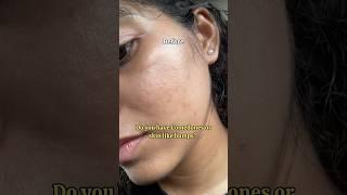 If you have comedones then Add these in your routine for next 3 months #skinbumps #comedones