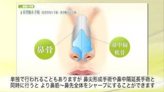 【東京美容外科】わかりやすい“鼻”の解説24A「鼻背縮小手術①鼻骨骨切り手術・鼻骨幅寄せ手術」