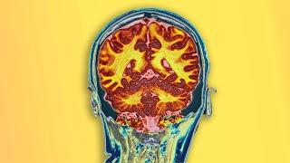 A Student Drank 2 Bottles Dextromethorphan. This Is What Happened To Her Brain.