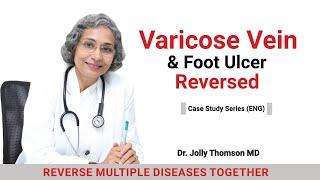 Varicose Vein & Foot Ulcer - Reversed