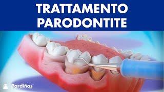 Trattamento parodontite – Curettage e sondaggio parodontale ©