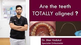 How do you know if teeth are COMPLETELY aligned?  |  Dr. Jiten Vadukul  |  The Orthodontist