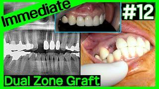 [Online Surgery] Immediate implant on #12 & dual zone graft