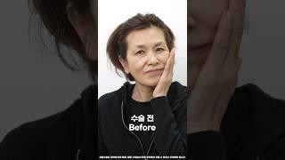 얼굴 전체 거상 3개월 후 ~ #안면거상 #동안성형