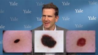 Computer Beats a Bunch of Dermatologists at Diagnosing Melanoma