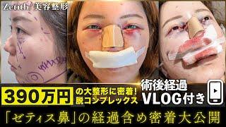 【整形】全顔美容整形の一部始終を密着大公開 / ダウンタイム中の経過映像も特別公開【くま取り・脂肪吸引・糸リフト・鼻整形・脂肪注入】#ゼティス鼻 #美容整形  #zetithbeautyclinic