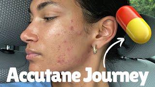 Starting my ACCUTANE journey (Isotretinoin) | Accutane side effects & process