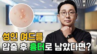 성인여드름과 학생여드름의 차이는?│성인여드름