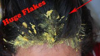 Wow!! Dandruff Scratching The Itchy Scalp!! Huge Dandruff Removal At Home # 163