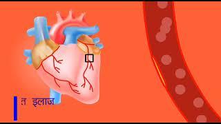 Heart treatment without surgery in Nashik #heartblockage #naturalbypass #chelation #eecp  #lowEF