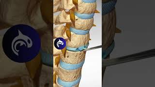 See how an Artificial Cervical Disc Replacement of the Spine works in 3D animation.