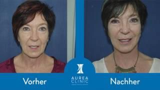 Zeuge Mónica Bleharoplastik