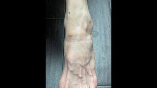 How Does A Vascular Surgeon Treat Foot Veins - Dr. Bush Explains!