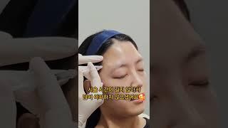 #측두근보톡스 관자놀이 #보톡스 #두통 까지 있다면