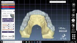 Placa miorrelaxante + Articulador Virtual | Alexandre Matias Dental Designer  | Exocad