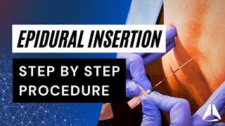 Epidural Insertion Technique | #anesthesiology #anesthesia #epidural